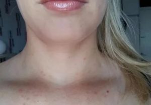 Мелкая сыпь по всему лицу и шее