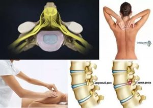 Лечение протрузии шейного отдела