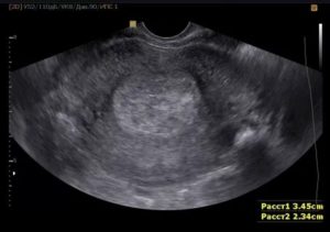 Матка при осмотре больше срока беременности по УЗИ