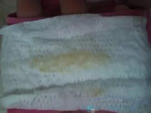 Желтые выделения на 7-8 неделе беременности