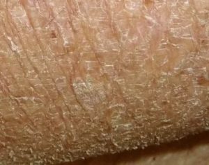 Как восстановить кожу на головке члена