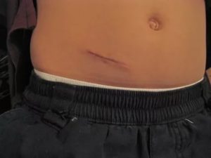 Разрастается шрам после аппендицита