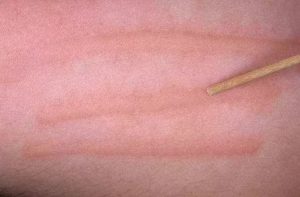 Сыпь в виде царапин