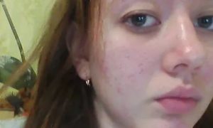 Прыщи в 18 лет