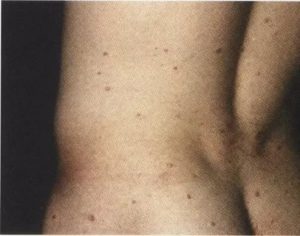 Сифилис ли это? Фото