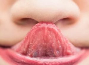 Наросты на бахромчатых складках языка