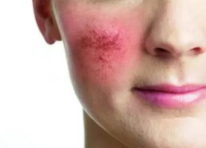 Розацеа-розовые угри