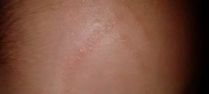 Сыпь в виде царапин