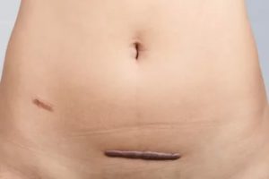 Разрастается шрам после аппендицита