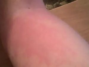 Сильное жжение кожи внизу живота и ляшках до колен