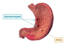 Острая язва антрального отдела желудка