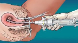 Первый секс после родов. Выделения