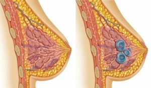 Твердые молочные железы