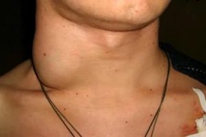 Шейная лимфаденопатия