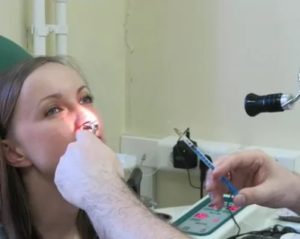 Вазомоторный ринит прижигание