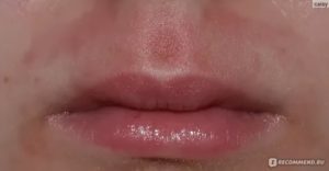 Шелушение над верхней губой с одной стороны белыми хлопьями