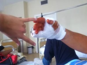 Отрезало половину подушечки пальца