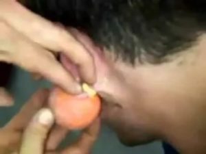 Сколько дней выходит гной из фурункула?