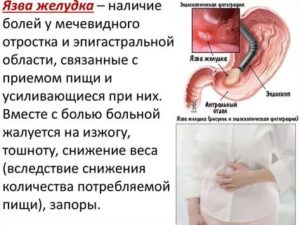 Боль под мечевидным отростком