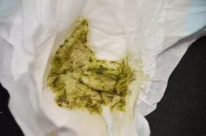 Сухой кал у ребенка