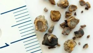 Песок в почках и температура 37/5