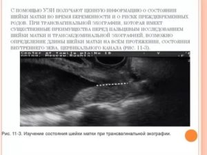 Матка при осмотре больше срока беременности по УЗИ