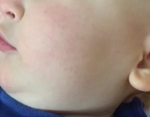 Температура и сыпь на лице