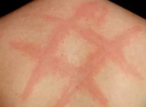 Красный дермографизм, зуд кожи