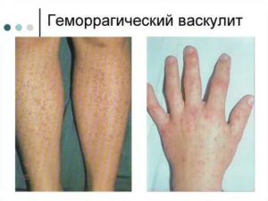 Геморрагический васкулит у ребенка