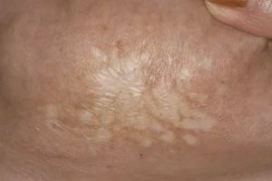 Пигментация на половой губе