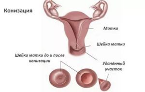 Секс после конизациии шейки матки