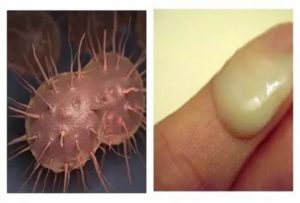 Узелки под головкой полового члена