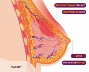 Уплотнение в груди у девочки 9 лет
