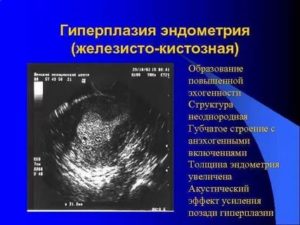 Неоднородный эндометрий, гиперплазия