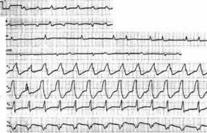 Ишемия ритма ST-T