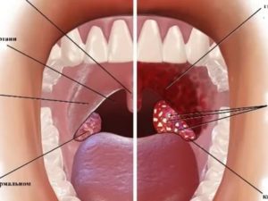 Ком в горле он то пропадает то появляется