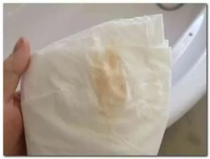 Желтые выделения на 7-8 неделе беременности