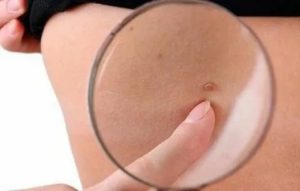 Папиллома при беременности