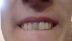 Потемнела десна над зубом после удаления нерва