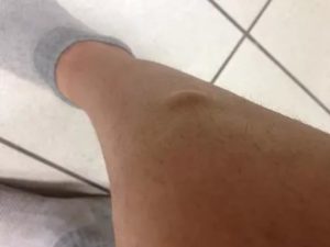 Шарик на вене