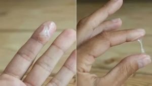 Белые густые выделения без запаха, боли в районе левого яичника