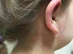 Пятно на ухе у ребёнка