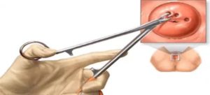 Секс после конизациии шейки матки