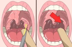 Горло саднит и ощущение кома