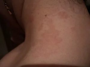 Светло-коричневые пятна на коже шеи