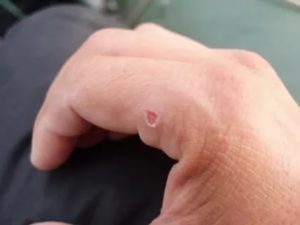 Увеличивающияся язвочка