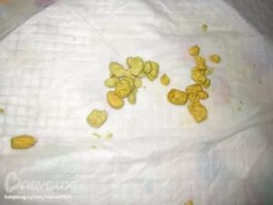 Ребенок какает шариками, как камyшки