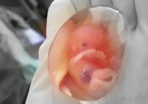 ОК после замершей беременности