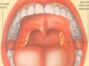 Желтый налёт и боль в горле