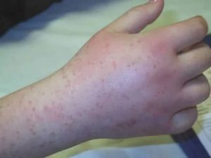 Геморрагический васкулит у ребенка